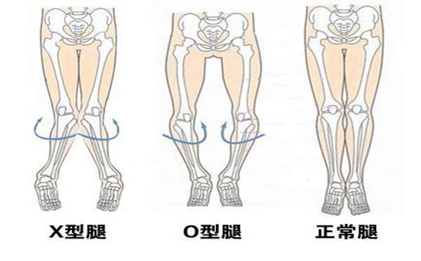 先天性膝关节畸形的症状