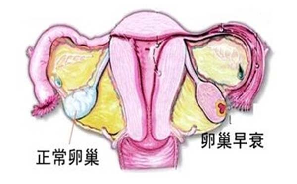 6年不孕 竟是子宫内膜异位症造成的