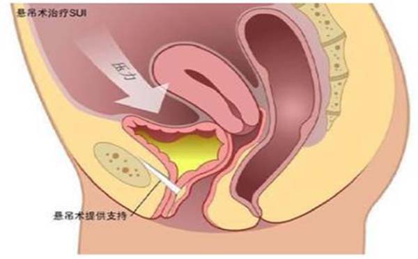 什么是子宫脱垂 哪些原因会导致子宫脱垂