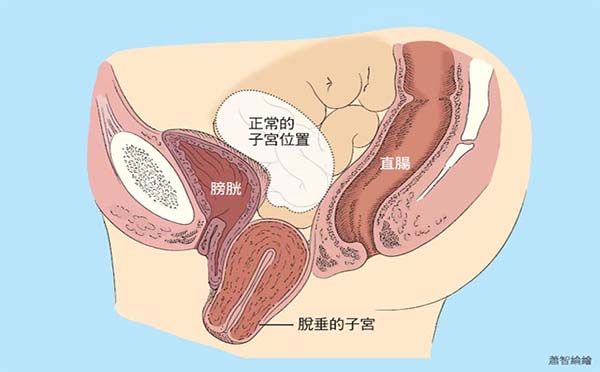 中老年女性经常被子宫脱垂所困扰　子宫脱垂是有分级的