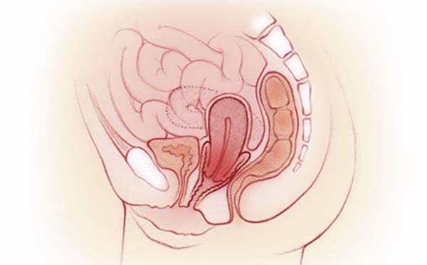 子宫脱垂对老人有哪些危害 子宫脱垂有什么感觉