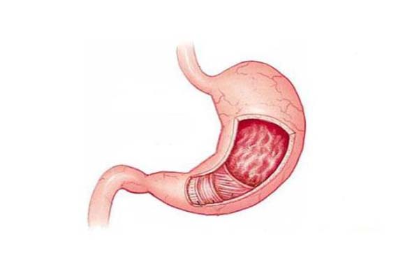 胃炎有什么常见并发症