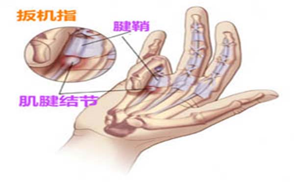 腱鞘炎的发病原因有哪些  看专家怎么说