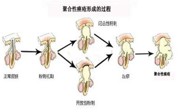 聚合性痤疮是怎么引起的 听专家怎么说