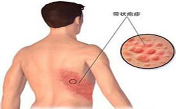 带状疱疹的发病原因有哪些 看专家怎么说