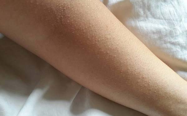 专家告诉你皮肤过敏会引起哪些并发症
