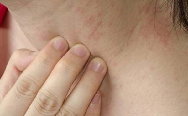专家告诉您 皮肤过敏什么原因导致的