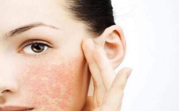 专家向您解答化妆品引起的皮肤过敏症状有哪些