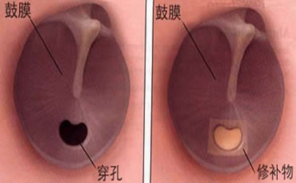 专家为您介绍各种不同原因可引起鼓膜穿孔