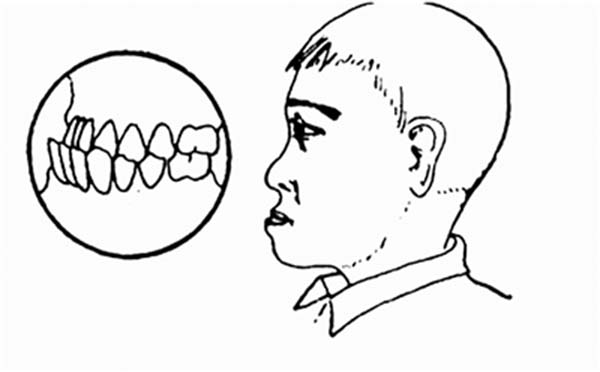 专家告诉您牙颌畸形的症状有哪些