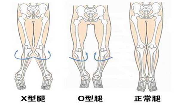 专家向您解答先天性膝关节畸形的症状表现是什么