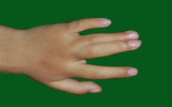 专家向您解答先天性并指多指畸形的原因及类型