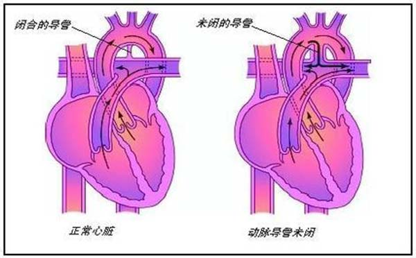 动脉导管未闭的症状