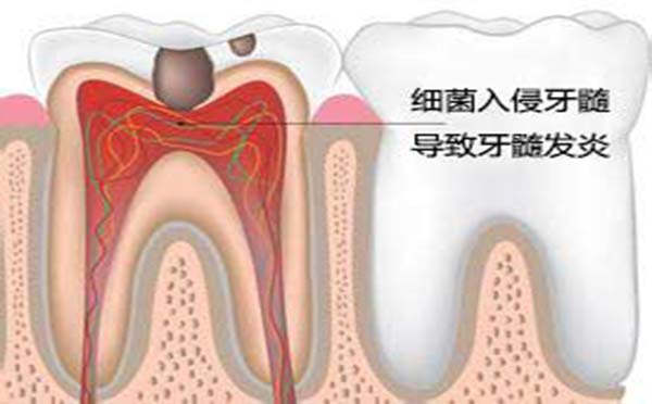 专家向您解答导致牙髓炎的原因有哪些