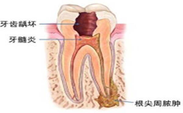 专家告诉您牙髓炎是什么症状