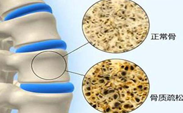 老太太胸椎不知原因骨折 竟是骨质疏松找上门