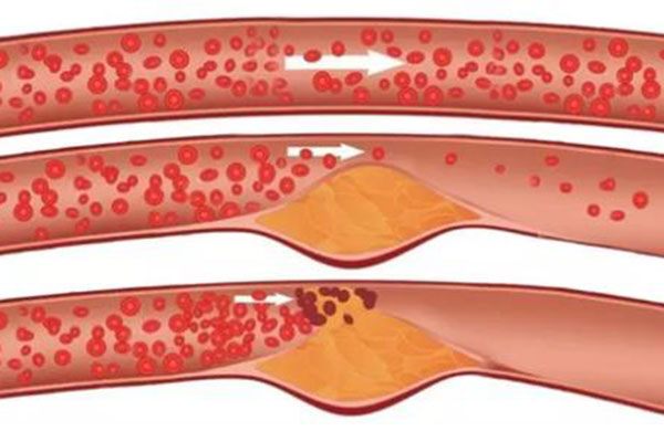 心血管堵了怎么调理