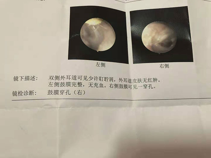 鼓膜穿孔修补后还会耳鸣吗