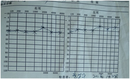 左边耳朵老是响听力图