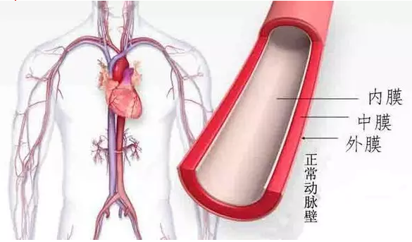 高血压如何引起动脉硬化
