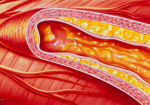 如何清楚血管中的垃圾，溶解血管斑块的药物有哪些