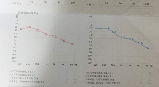 这是听力逐渐下降的听力表