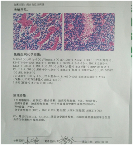 胶质瘤甲基化是好事吗