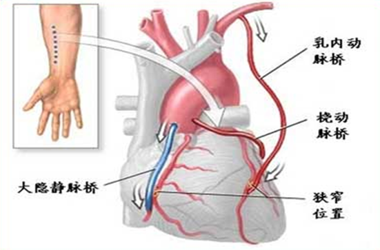 心脏支架和搭桥有什么区别一样吗?