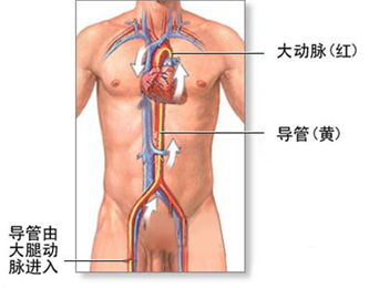 心脏支架和搭桥有什么区别一样吗?