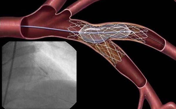心脏血管支架