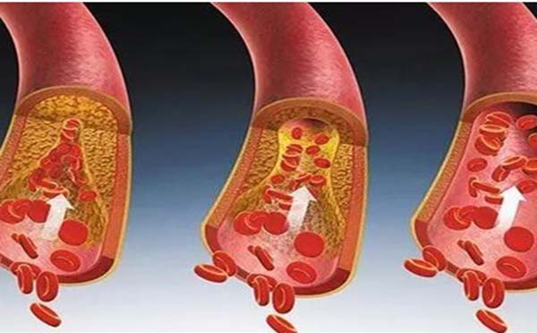 防治动脉粥样硬化