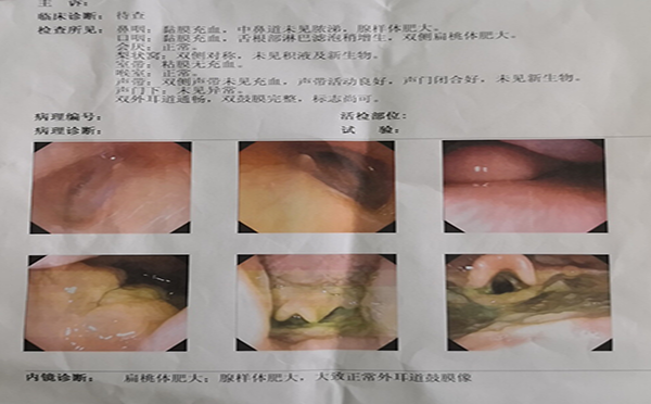 扁桃体肥大腺样体肥大需要手术治疗吗