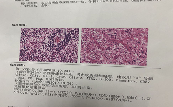 胶质瘤术后高烧不退