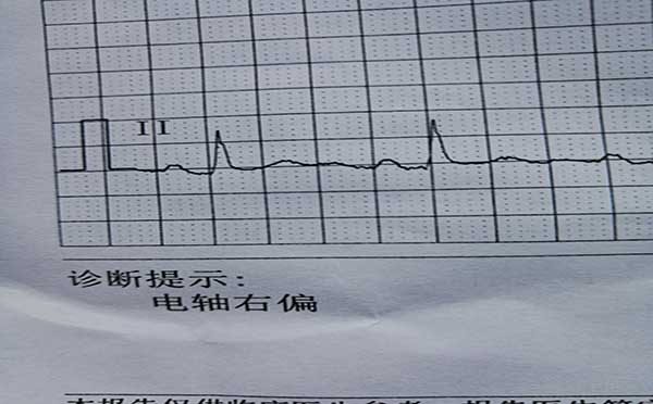 胸部ct主动脉硬化严重吗